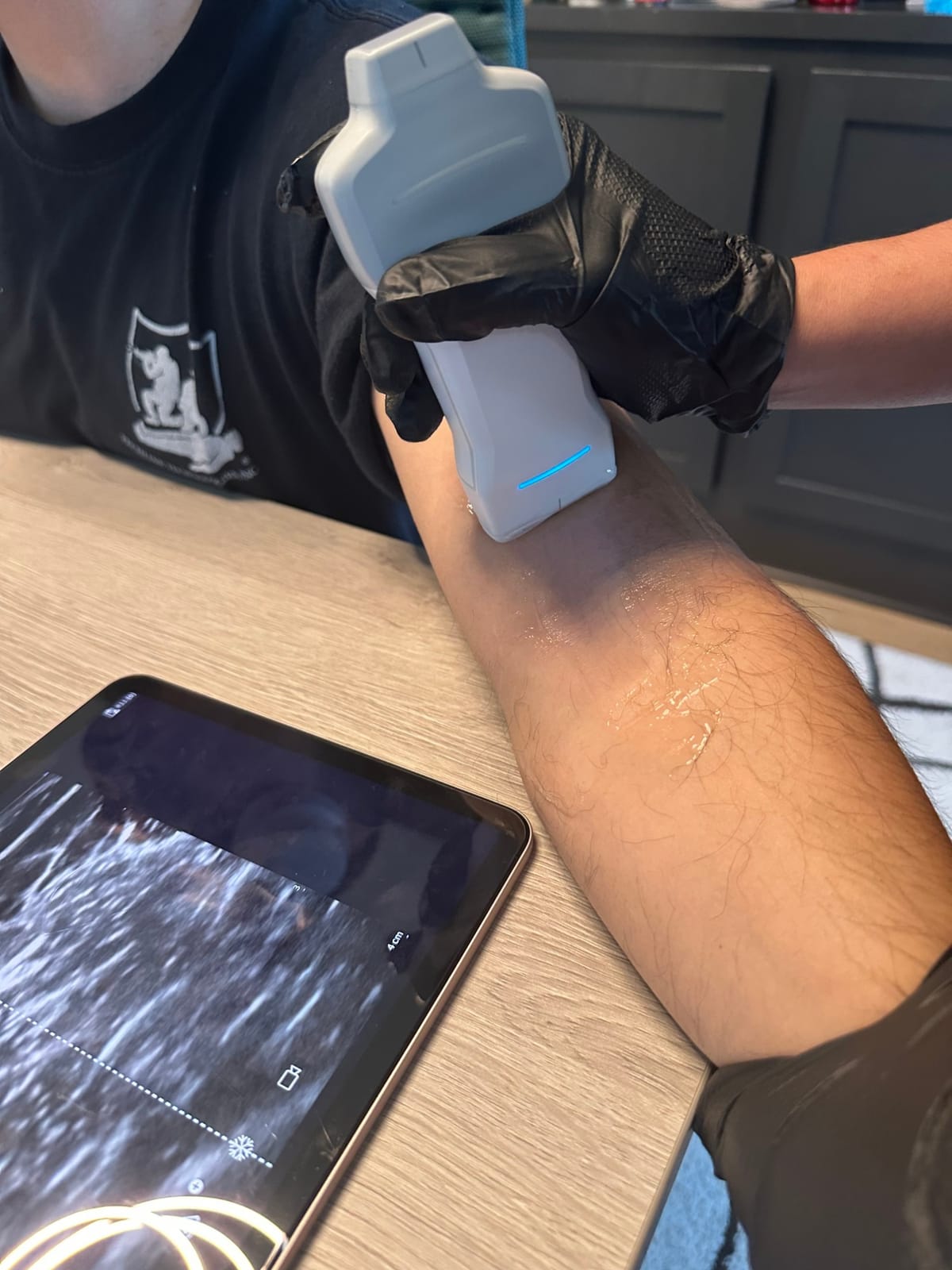 Handheld ultrasound probe locating a vein on a client's arm